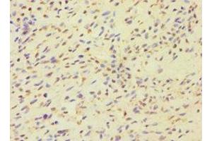 Immunohistochemistry of paraffin-embedded human breast cancer using ABIN7159821 at dilution of 1:100 (MCMBP antibody  (AA 1-240))