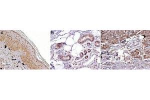 Expression of MC1R in normal skin and melanoma - Immunohistochemical staining of paraffin embedded normal skin and melanoma sections using Anti-MC1 Receptor Antibody (ABIN7043321, ABIN7044592 and ABIN7044593) (1:100). (MC1 Receptor antibody  (AA 217-232))