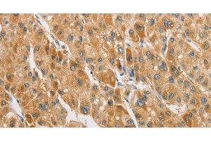 Immunohistochemistry of paraffin-embedded Human liver cancer tissue using ARHGAP5 Polyclonal Antibody at dilution 1:30 (ARHGAP5 antibody)