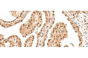 Immunohistochemistry of paraffin-embedded Human thyroid cancer tissue using LGALS4 Polyclonal Antibody at dilution of 1:30(x200) (GAL4 antibody)