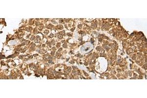 Immunohistochemistry of paraffin-embedded Human ovarian cancer tissue using RBL2 Polyclonal Antibody at dilution of 1:45(x200) (p130 antibody)