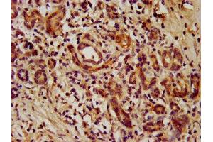 IHC image of ABIN7172763 diluted at 1:1000 and staining in paraffin-embedded human pancreatic cancer performed on a Leica BondTM system. (TEAD3 antibody  (AA 112-435))