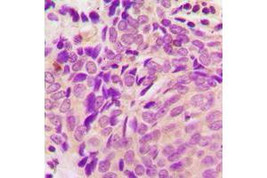 Immunohistochemical analysis of Beta-tubulin staining in human breast cancer formalin fixed paraffin embedded tissue section. (TUBB antibody  (C-Term))