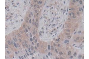 DAB staining on IHC-P; Samples: Human Lung cancer Tissue (PPIA antibody  (AA 2-165))