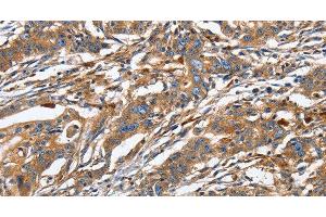Immunohistochemistry of paraffin-embedded Human gastric cancer using GNA13 Polyclonal Antibody at dilution of 1:30 (GNA13 antibody)
