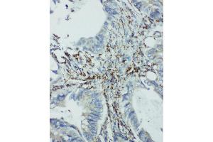 Anti-integrin beta 4 binding protein antibody, IHC(P) IHC(P): Human Intestinal Cancer Tissue (EIF6 antibody  (Middle Region))