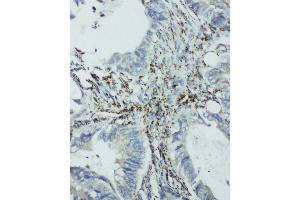 Anti-integrin beta 4 binding protein antibody, IHC(P) IHC(P): Human Intestinal Cancer Tissue