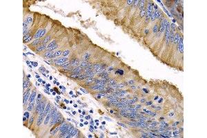 Immunohistochemistry of paraffin-embedded Human colon cancer using IL9 Polyclonal Antibody at dilution of 1:200 (40x lens). (IL-9 antibody)