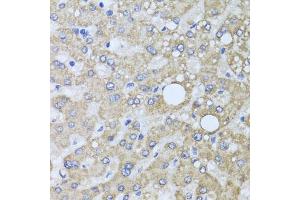 Immunohistochemistry of paraffin-embedded human liver injury using AARS2 antibody. (AARS2 antibody)