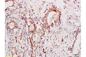 Formalin-fixed and paraffin embedded human breast cancer labeled with Anti-CA153/MUC1/KL-6 Polyclonal Antibody, Unconjugated (ABIN687367) at 1:200 followed by conjugation to the secondary antibody and DAB staining. (MUC1 antibody  (AA 1101-1255))
