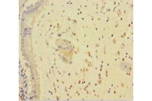Immunohistochemistry of paraffin-embedded human lung cancer using ABIN7167811 at dilution of 1:100 (RARRES3 antibody  (AA 1-133))