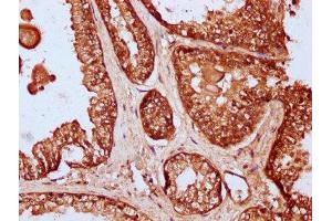 IHC image of ABIN7166010 diluted at 1:200 and staining in paraffin-embedded human prostate cancer performed on a Leica BondTM system.