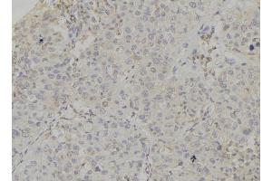 ABIN6272856 at 1/100 staining Human breast cancer tissue by IHC-P. (Caprin-1 antibody  (Internal Region))