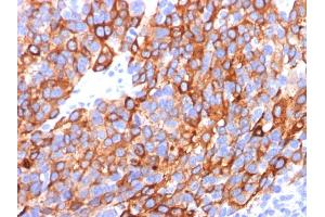 Formalin-fixed, paraffin-embedded human Melanoma stained with MART-1 / Melan-A Monoclonal Antibody (A103+M2-7C10+M2-9E3). (MLANA antibody)