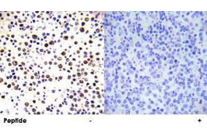 Immunohistochemical analysis of paraffin-embedded human malignant lymphoma tissue using HIST1H3E (phospho T3) polyclonal antibody .
