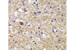 Immunohistochemistry of paraffin-embedded Human brain cancer using CDK6 Polyclonal Antibody at dilution of 1:100 (40x lens). (CDK6 antibody)