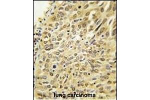 Formalin-fixed and paraffin-embedded human lung carcinoma tissue reacted with Dsk2 Antibody (N-term) (ABIN388963 and ABIN2839210) , which was peroxidase-conjugated to the secondary antibody, followed by DAB staining. (Ubiquilin 1 antibody  (N-Term))