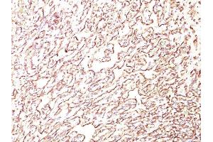 Formalin-fixed, paraffin-embedded human Angiosarcoma stained with Podocalyxin Monoclonal Antibody (4F10). (PODXL antibody  (Extracellular Domain))
