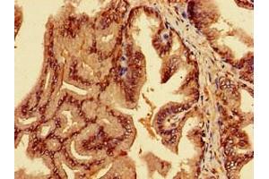 Immunohistochemistry of paraffin-embedded human prostate cancer using ABIN7151962 at dilution of 1:100