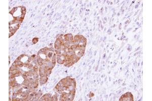 IHC-P Image Immunohistochemical analysis of paraffin-embedded NCIN87 xenograft, using TCP-1 epsilon, antibody at 1:500 dilution. (CCT5 antibody)