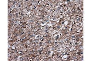 Immunohistochemical staining of paraffin-embedded Carcinoma of liver tissue using anti-IFIT1 mouse monoclonal antibody. (IFIT1 antibody)