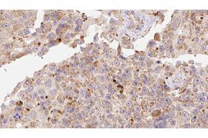 ABIN6278123 at 1/100 staining Human Melanoma tissue by IHC-P. (APOC3 antibody  (Internal Region))