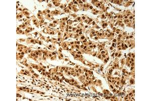 Immunohistochemistry of Human breast cancer using C12orf5 Polyclonal Antibody at dilution of 1:80 (TIGAR antibody)