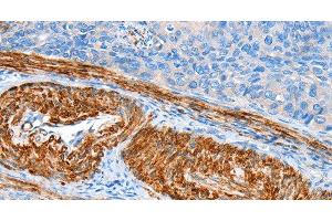 Immunohistochemistry of paraffin-embedded Human cervical cancer tissue using AARS Polyclonal Antibody at dilution 1:60 (AARS antibody)