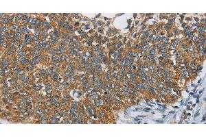 Immunohistochemistry of paraffin-embedded Human cervical cancer tissue using ANKHD1 Polyclonal Antibody at dilution 1:40 (ANKHD1 antibody)