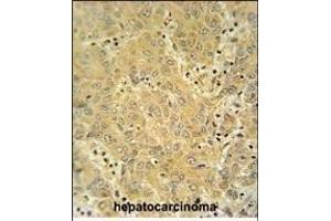 CYP2A7 antibody (Center) (ABIN654434 and ABIN2844170) immunohistochemistry analysis in formalin fixed and paraffin embedded human hepatocarcinoma followed by peroxidase conjugation of the secondary antibody and DAB staining. (CYP2A7 antibody  (AA 121-148))