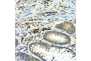 Immunohistochemistry of paraffin-embedded human colon carcinoma using MMP9 Rabbit pAb (ABIN6134758, ABIN6143921, ABIN6143924 and ABIN6215080) at dilution of 1:100 (40x lens). (MMP 9 antibody  (AA 400-500))