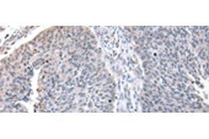 Immunohistochemistry of paraffin-embedded Human lung cancer tissue using ZNF23 Polyclonal Antibody at dilution of 1:50(x200) (ZNF23 antibody)