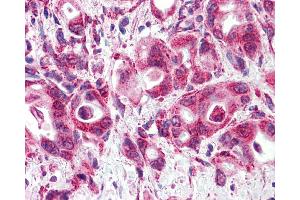 Anti-GLP1R/GLP-1R/GLP-1 Receptor antibody IHC of human Pancreas, Carcinoma. (GLP1R antibody  (N-Term))