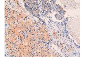 IHC-P analysis of Human Lung Cancer Tissue, with DAB staining. (OIT3 antibody  (AA 297-506))