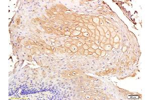 Formalin-fixed and paraffin embedded human endometrial cancer labeled with Anti-CD44v7 Polyclonal Antibody, Unconjugated (ABIN680578) at 1:200 followed by conjugation to the secondary antibody and DAB staining (CD44v7 antibody  (AA 201-300))