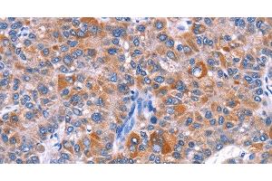 Immunohistochemistry of paraffin-embedded Human liver cancer tissue using ELP2 Polyclonal Antibody at dilution 1:40 (ELP2 antibody)