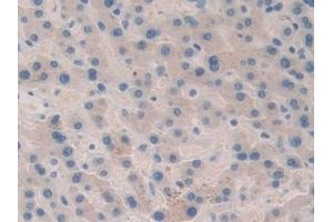 Detection of F5 in Human Liver cancer Tissue using Polyclonal Antibody to Coagulation Factor V (F5) (Coagulation Factor V antibody  (AA 463-715))