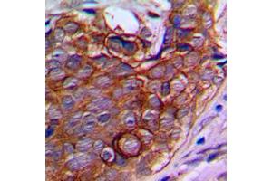Immunohistochemical analysis of NPDC1 staining in human prostate cancer formalin fixed paraffin embedded tissue section. (NPDC1 antibody  (Center))