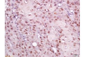 Formalin-fixed and paraffin embedded human laryngeal tissue labeled with Rabbit Anti-EIF3S4 Polyclonal Antibody, Unconjugated (ABIN2559611) at 1:200 followed by conjugation to the secondary antibody and DAB staining (EIF3G antibody  (AA 51-150))