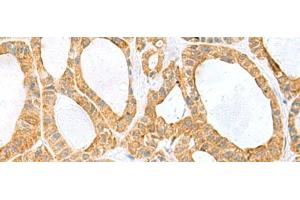 Immunohistochemistry of paraffin-embedded Human thyroid cancer tissue using PPIH Polyclonal Antibody at dilution of 1:60(x200) (PPIH antibody)