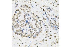 Immunohistochemistry of paraffin-embedded human esophageal cancer using PSMB1 antibody. (PSMB1 antibody  (AA 29-241))