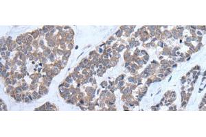 Immunohistochemistry of paraffin-embedded Human esophagus cancer tissue using CNTN1 Polyclonal Antibody at dilution of 1:35(x200) (Contactin 1 antibody)