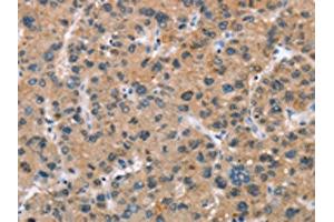 The image on the left is immunohistochemistry of paraffin-embedded Human liver cancer tissue using ABIN7189673(ADGRB2 Antibody) at dilution 1/25, on the right is treated with synthetic peptide. (BAI2 antibody)