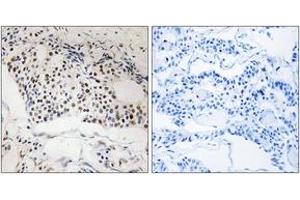 Immunohistochemistry analysis of paraffin-embedded human breast carcinoma, using MYSM1 Antibody.
