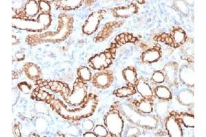 IHC testing of FFPE human renal cell carcinoma with recombinant Cadherin 16 antibody (clone CDH16/1532R). (Recombinant Cadherin-16 antibody)