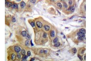 Immunohistochemistry analyzes of ErbB-3 antibody in paraffin-embedded human breast carcinoma tissue. (ERBB3 antibody)