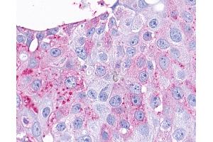Anti-TAAR9 antibody IHC of human Breast, Carcinoma.