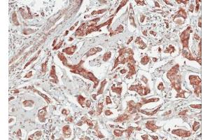 IHC-P Image Immunohistochemical analysis of paraffin-embedded human breast cancer, using TULP1, antibody at 1:100 dilution.