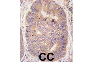 Formalin-fixed and paraffin-embedded human colon carcinoma tissue reacted with TASP1 polyclonal antibody  , which was peroxidase-conjugated to the secondary antibody, followed by DAB staining.