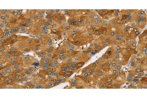 Immunohistochemistry of paraffin-embedded Human liver cancer using TNFSF15 Polyclonal Antibody at dilution of 1:40 (TNFSF15 antibody)